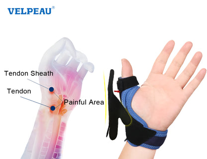 OctoGrip: Octopus-Inspired Thumb Splint for Tenosynovitis and Arthritis